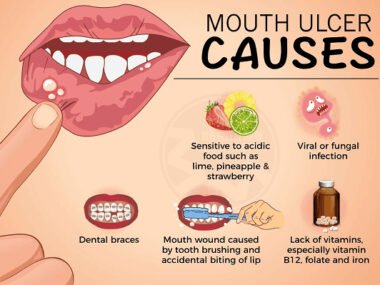 Canker Sores (Mouth Ulcers): Causes, Treatment and When to See a Doctor